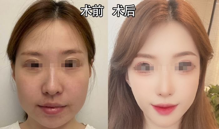 什么是微创改脸型？手术详细介绍及各种手术方法讲解