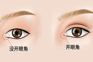 韩式微创开眼角需要伤口拆线吗?