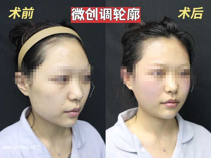什么是微创改脸型？手术详细介绍及各种手术方法讲解