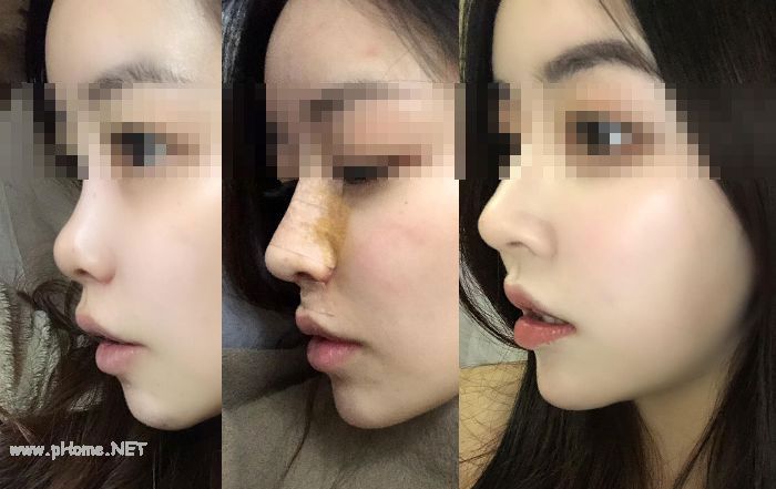 鼻尖塑形：定义与价格解析
